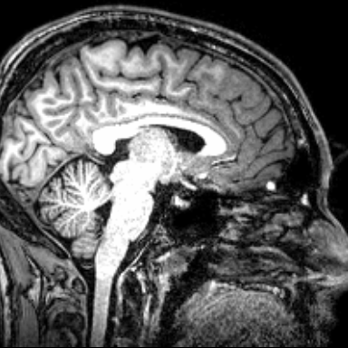 Ausschnitt aus einem MRI-Scan des Gehirns 
